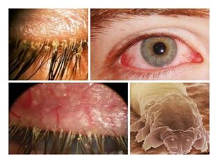 symptoms of the presence of parasites under the human skin